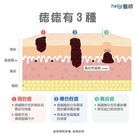 為什麼會長黑痣|痣變大、痣多或長毛會變皮膚癌？認識痣的形成與原因